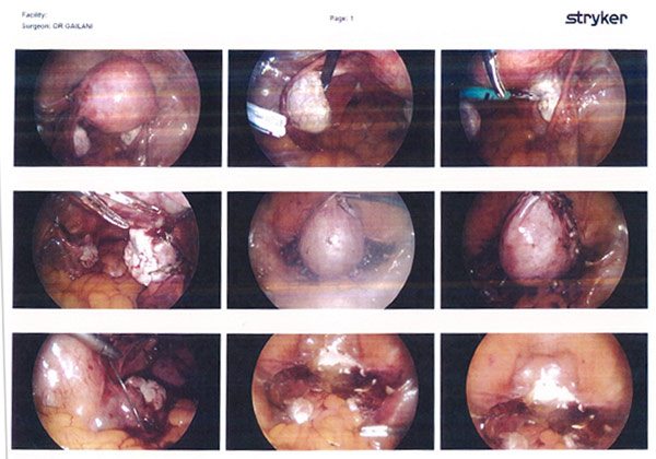 A 47-year-old patient presented with bleeding and abdominal pain