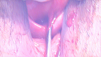 A Large Multifibroid Uterus, Cervical Fibroid Causing Urinary Retention