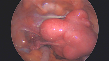 A Large Multifibroid Uterus, Cervical Fibroid Causing Urinary Retention