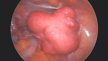 A Large Multifibroid Uterus, Cervical Fibroid Causing Urinary Retention