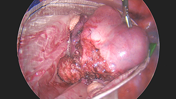A Large Multifibroid Uterus, Cervical Fibroid Causing Urinary Retention