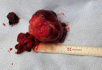 Evulsion of a Large Fibroid