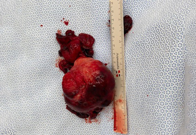 Evulsion of a Large Fibroid