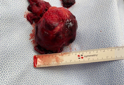 Evulsion of a Large Fibroid