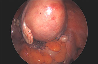 Fibroid Uterus