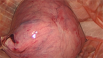 Laparoscopic Subtotal Hysterectomy and Morcellation of a Fibroid Uterus and Espiner Bag