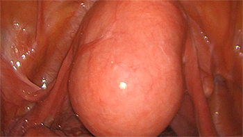 Laparoscopic Subtotal Hysterectomy and Morcellation of a Fibroid Uterus and Espiner Bag