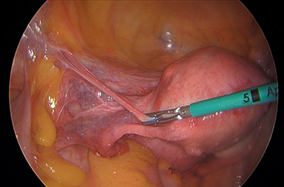 Laparoscopic Hysterectomy for Large Posterior Uterine Fibroid