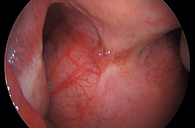 Laparoscopic Hysterectomy for Large Posterior Uterine Fibroid