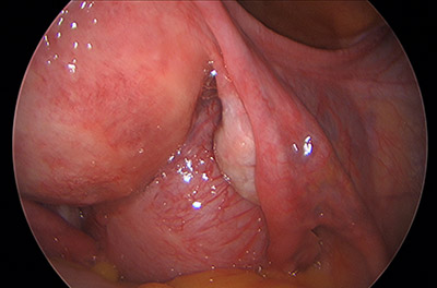 Laparoscopic Hysterectomy for Large Posterior Uterine Fibroid