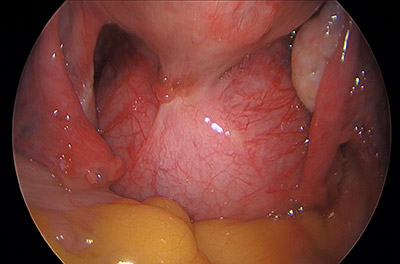 Laparoscopic Hysterectomy for Large Posterior Uterine Fibroid