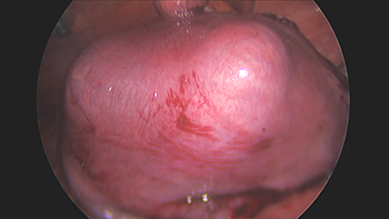 Laparoscopic Hysterectomy