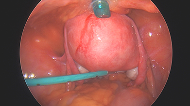 Laparoscopic Subtotal Hysterectomy for an Enlarged Uterus with Adenomyosis