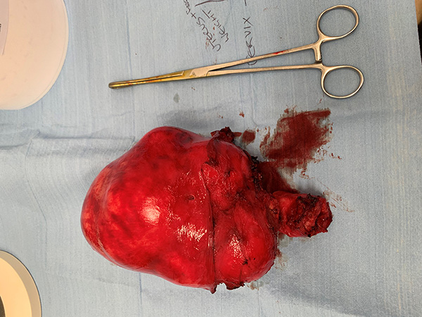 Large Fibroid Uterus