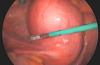 Ultrasound showed a large uterus measuring up to 14cm with a 7.5cm fibroid in addition to other smaller fibroids