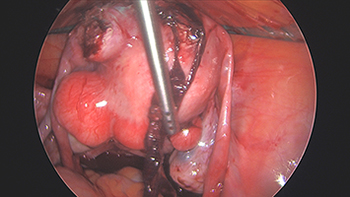 Large Multiple Uterine Fibroids and Endometriosis.