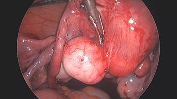 Large Multiple Uterine Fibroids and Endometriosis.