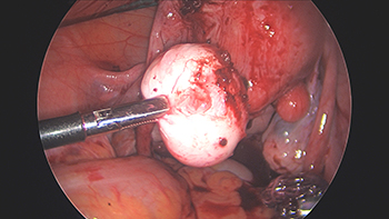 Large Multiple Uterine Fibroids and Endometriosis.