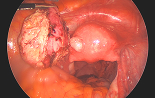 Laparoscopic Removal of Fibroid (Myomectomy)