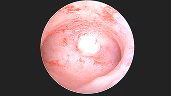 Submucosal Fibroid