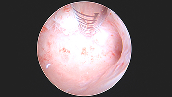 Submucosal Fibroid