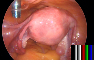 Laparoscopic Subtotal Hysterectomy for Large Uterine Fibroids.