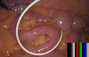 Laparoscopic Subtotal Hysterectomy for Large Uterine Fibroids.