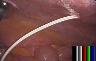 Laparoscopic Subtotal Hysterectomy for Large Uterine Fibroids.