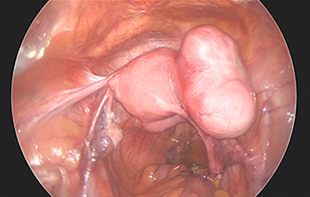 Total Laparoscopic Hysterectomy for a large fibroid uterus and uterine prolapse