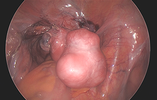 Total Laparoscopic Hysterectomy for a large fibroid uterus and uterine prolapse