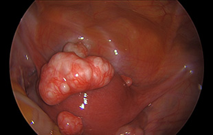 Uterine Fibroids