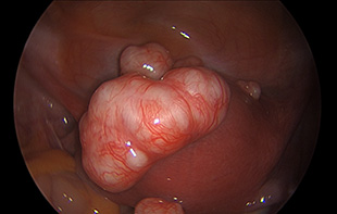 Uterine Fibroids