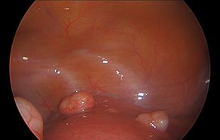 Uterine Fibroids