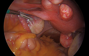 Uterine Fibroids