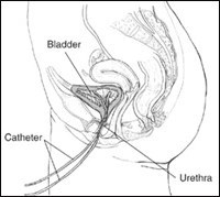 urinary incontinence2