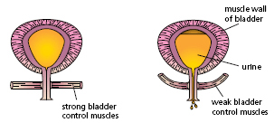 urinary incontinence