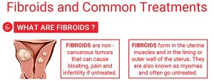 fibroids-and-common-treatements-img
