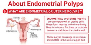 endometrial-polyps-blog